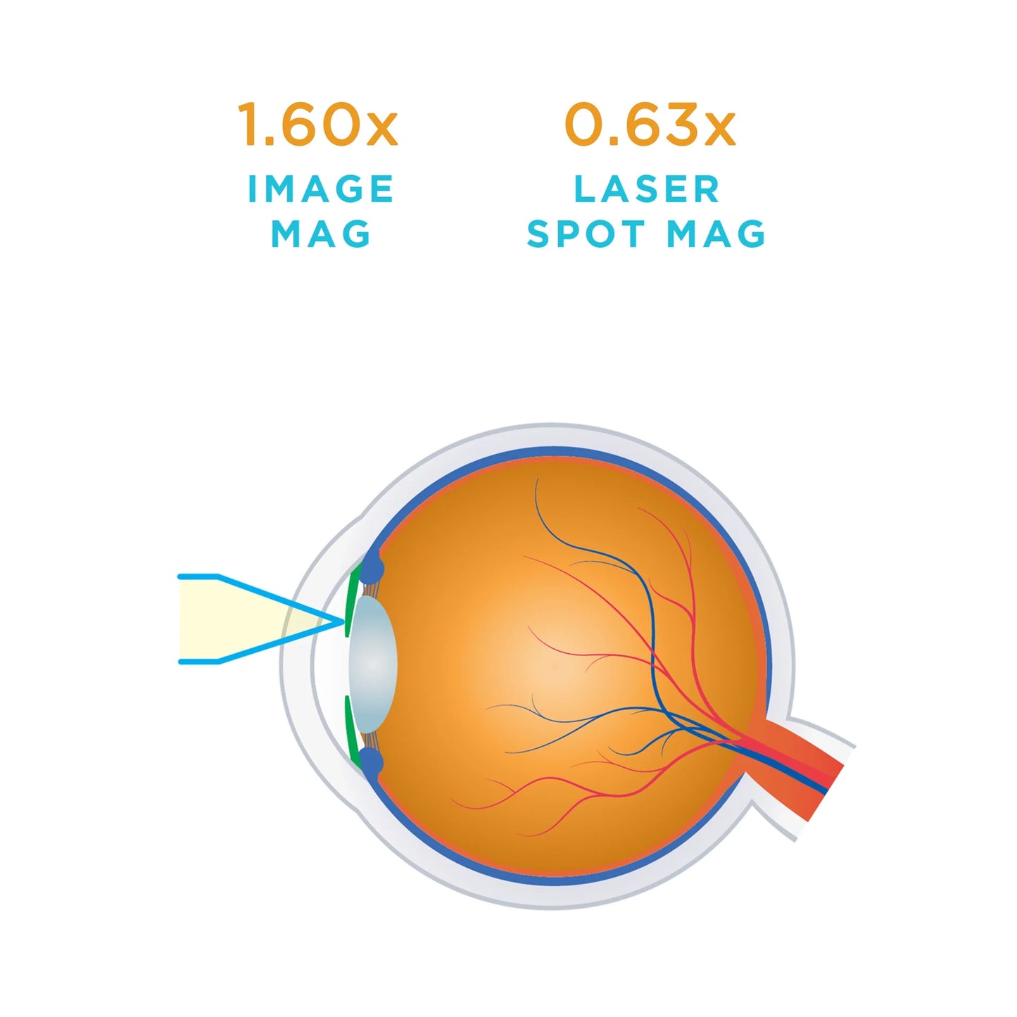 Mag Plus Iridectomy Lens