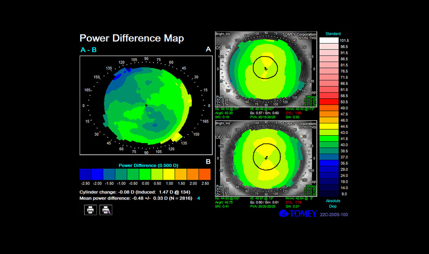 TMS-4N Corneal Topographer