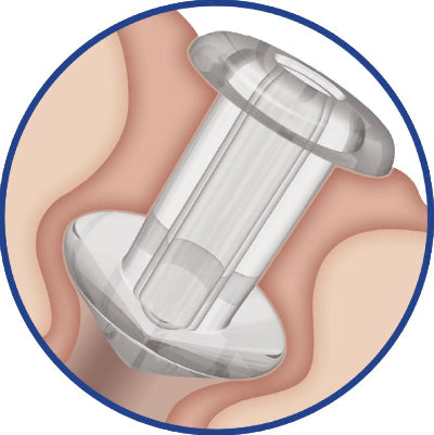 SOFT PLUG Silicone Punctal Plugs (20 per Box)
