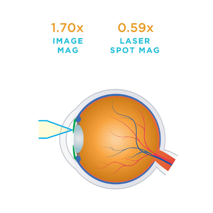 Iridectomy Lens