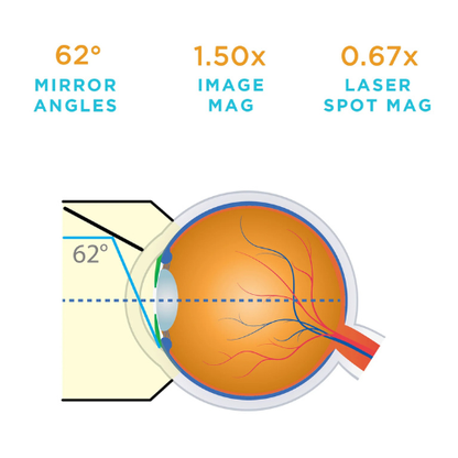 One Mirror Glass Trabeculum Lens