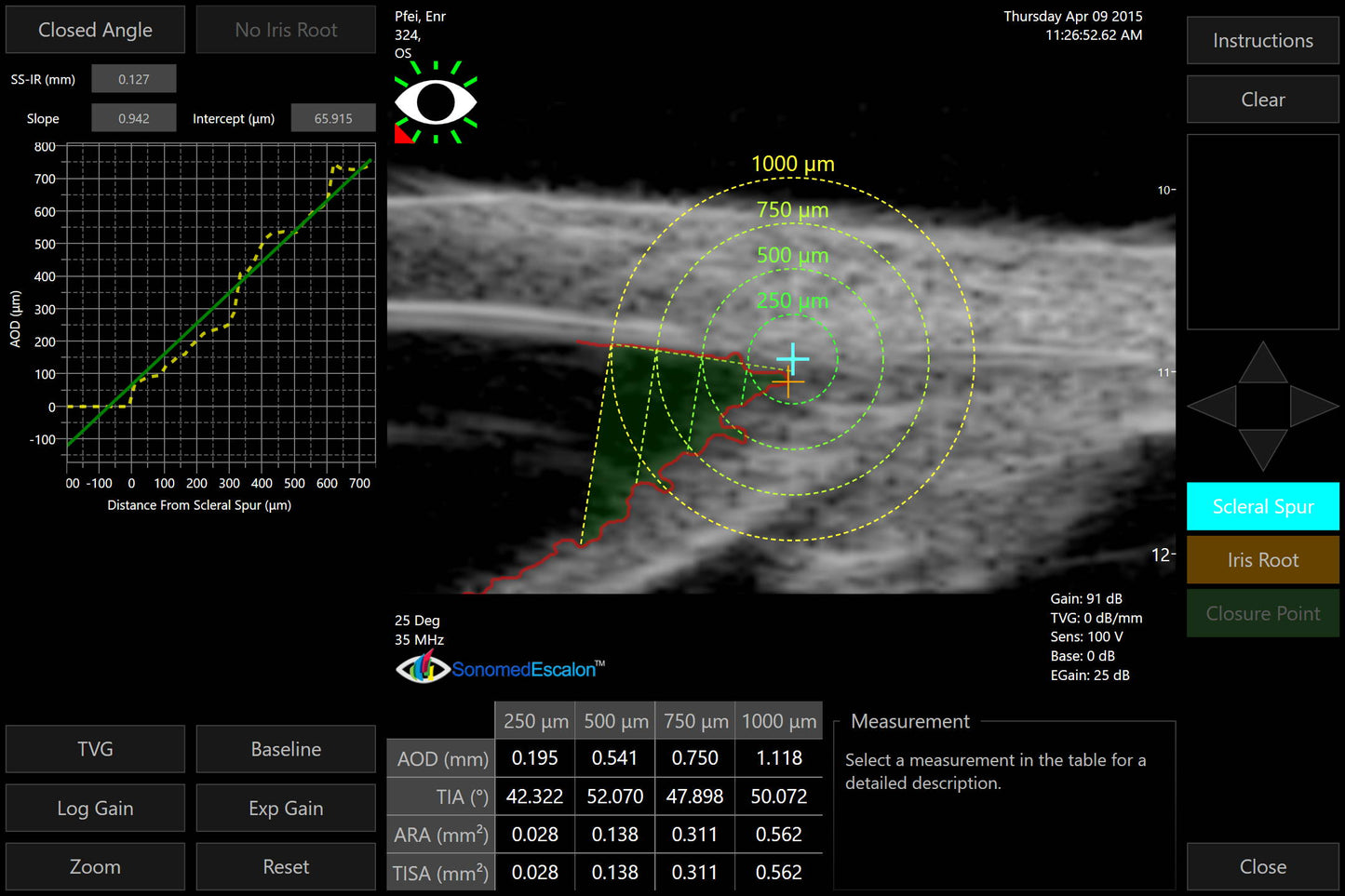 VuPad Portable Ophthalmic Ultrasound